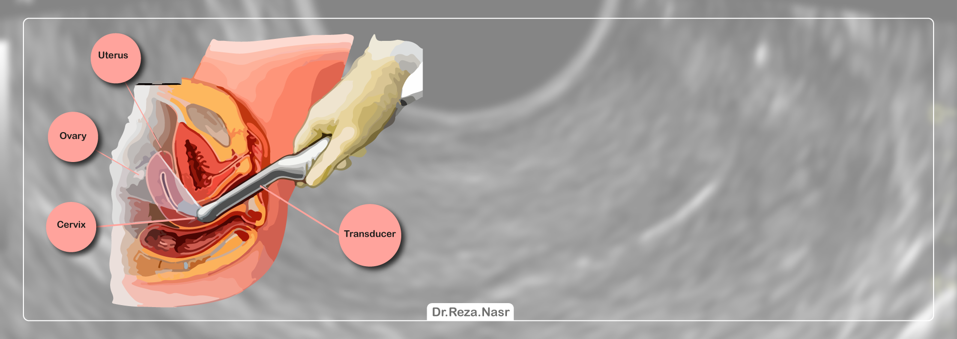 Ultrasound transvaginal Transvaginal ultrasound